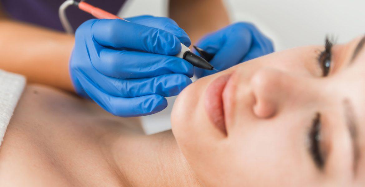 Elektrolyse Ontharing